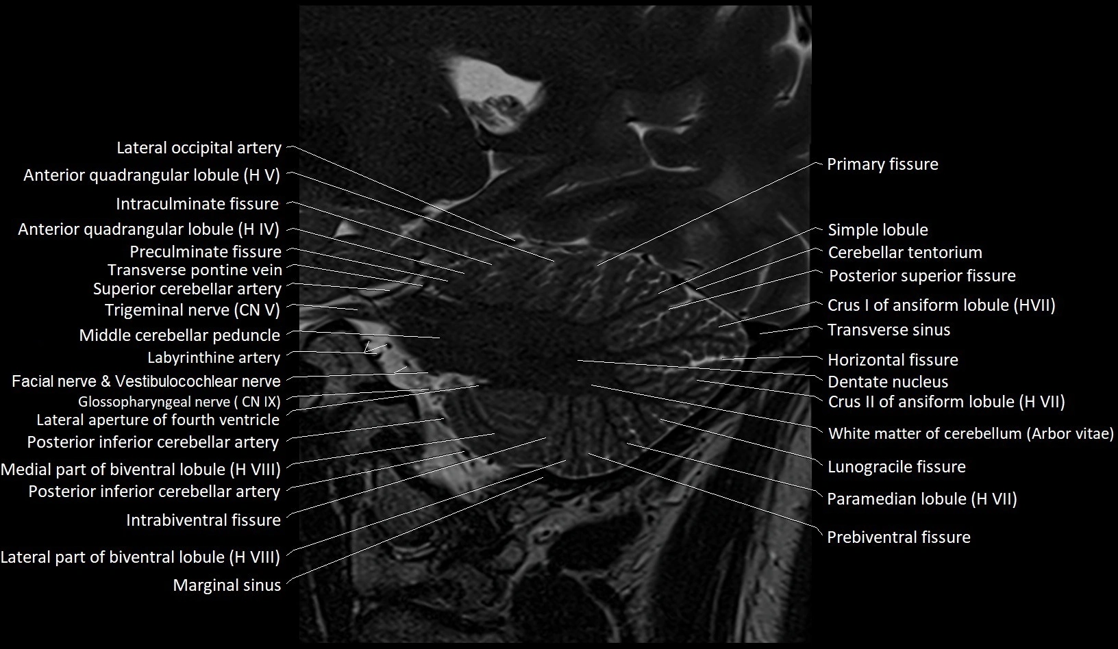 MRI Cerebellar anatomy sagittal High-resolution labelled image 21.webp